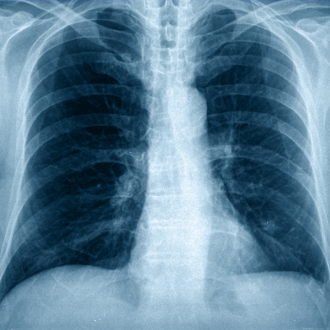 X-ray image of a human chest highlighting the ribs.